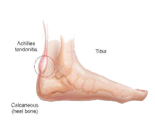 Masalah Kaki - ARCHILES TENDONIS Masalah Kaki - ARCHILES TENDONIS