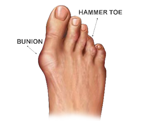 Masalah Kaki - BUNION HT Masalah Kaki - BUNION HT