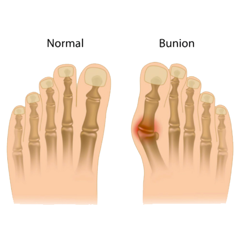 Masalah Kaki - BUNION HT 2 copy Masalah Kaki - BUNION HT 2 copy