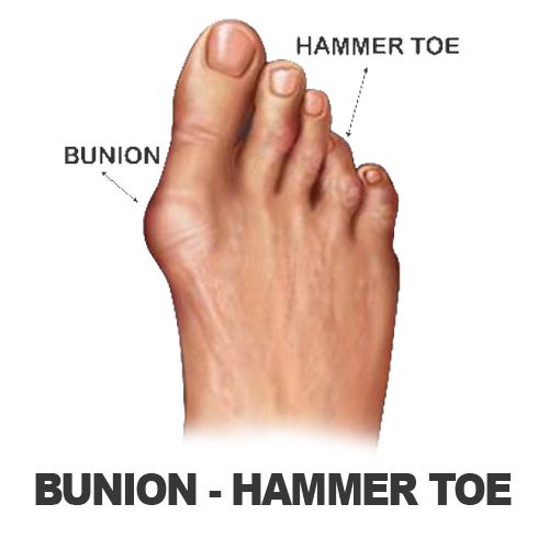Masalah Kaki - BUNION HT Masalah Kaki - BUNION HT