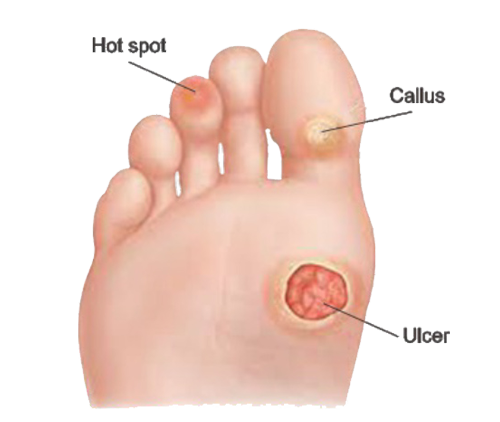 Masalah Kaki - CALLUSES Masalah Kaki - CALLUSES