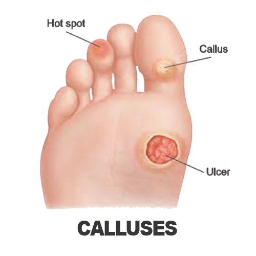 Masalah Kaki - CALLUSES Masalah Kaki - CALLUSES