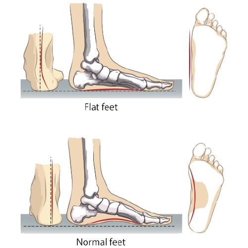 Masalah Kaki - FLAT FOOT 2 copy Masalah Kaki - FLAT FOOT 2 copy