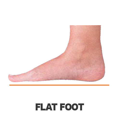 Masalah Kaki - FLAT FOOT Masalah Kaki - FLAT FOOT
