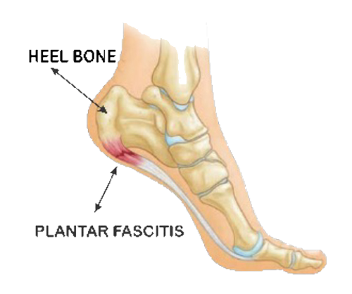 Masalah Kaki - HEEL SPUR Masalah Kaki - HEEL SPUR