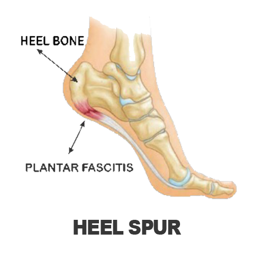 Masalah Kaki - HEEL SPUR Masalah Kaki - HEEL SPUR