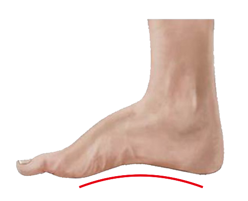 Masalah Kaki - HIGH ARCH FOOT Masalah Kaki - HIGH ARCH FOOT