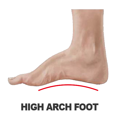Masalah Kaki - HIGH ARCH FOOT Masalah Kaki - HIGH ARCH FOOT