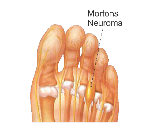 Masalah Kaki - MORTON'S NEUROMA Masalah Kaki - MORTON'S NEUROMA