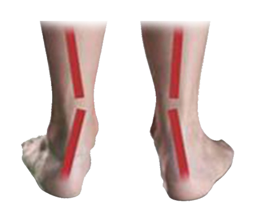 Masalah Kaki - PRONATION Masalah Kaki - PRONATION