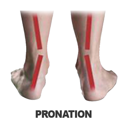 Masalah Kaki - PRONATION Masalah Kaki - PRONATION